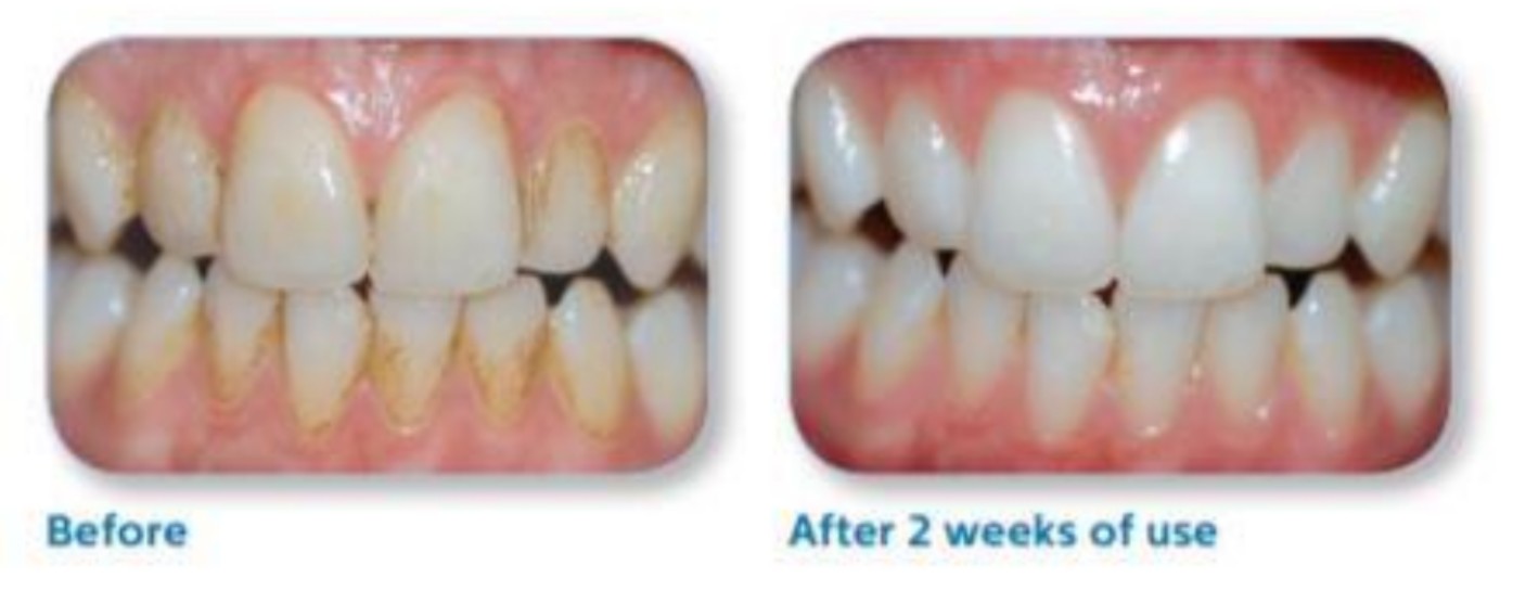 A fogak árnyalatváltozásának vizsgálata Sonicare elektromos fogkefe használatától